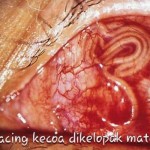 cacing-kecoa-di-mata