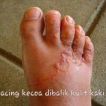 kaki-akibat-kecoa
